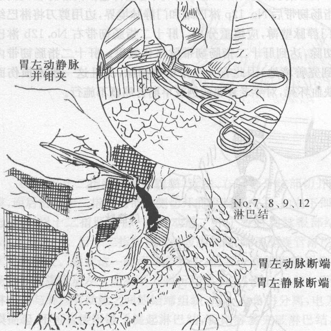二、胃癌淋巴結(jié)廓清步驟